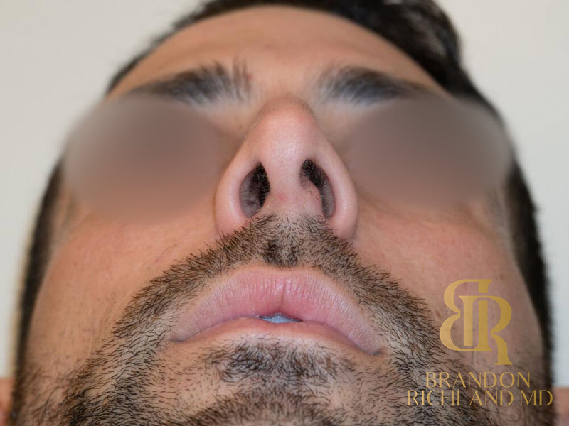 Rhinoplasty Before & After Image