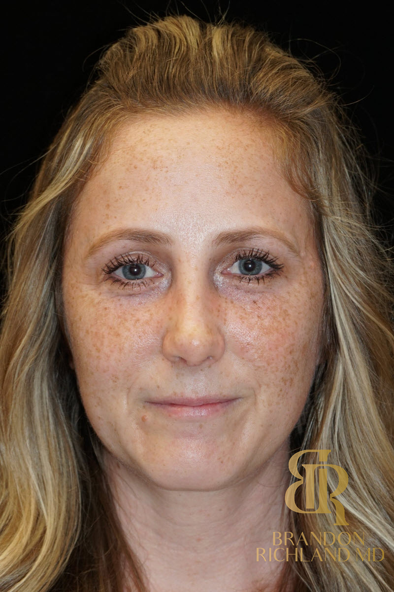 Rhinoplasty Before & After Image