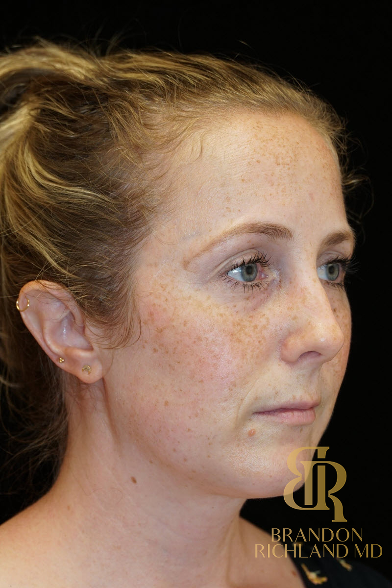 Rhinoplasty Before & After Image