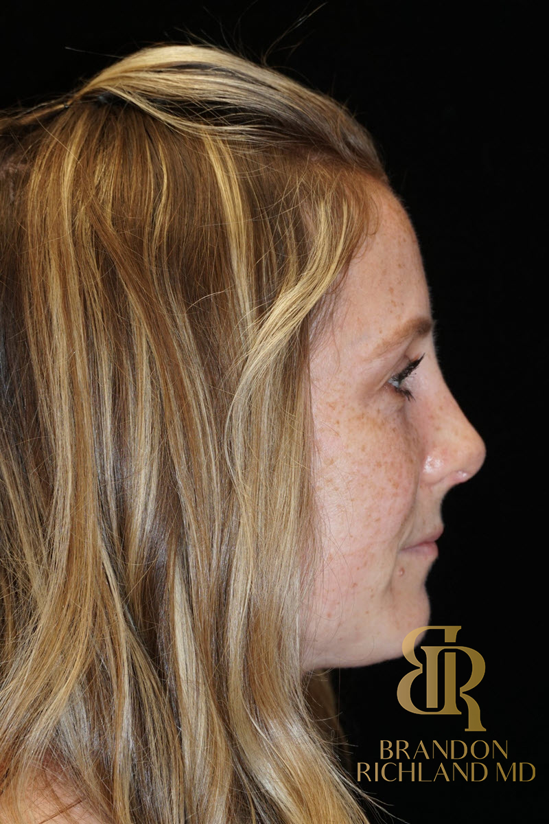 Rhinoplasty Before & After Image