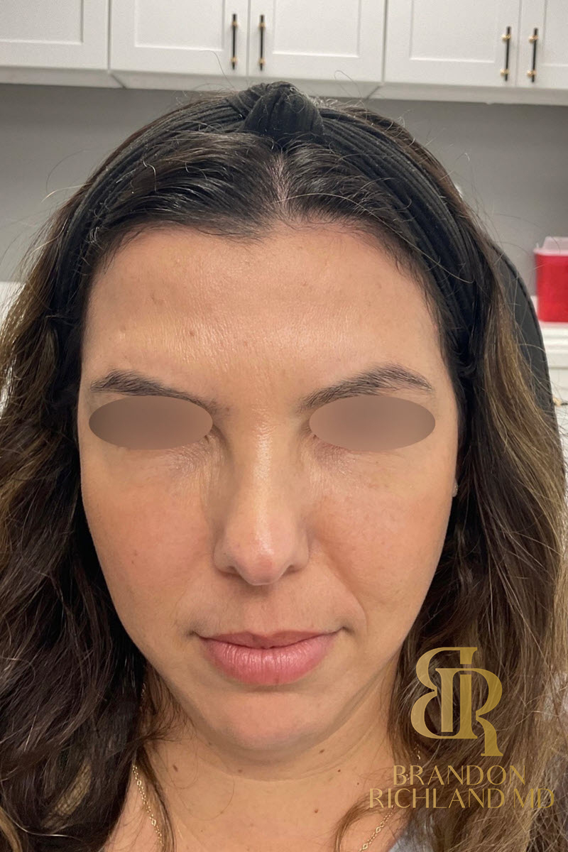 Botox Before & After Image