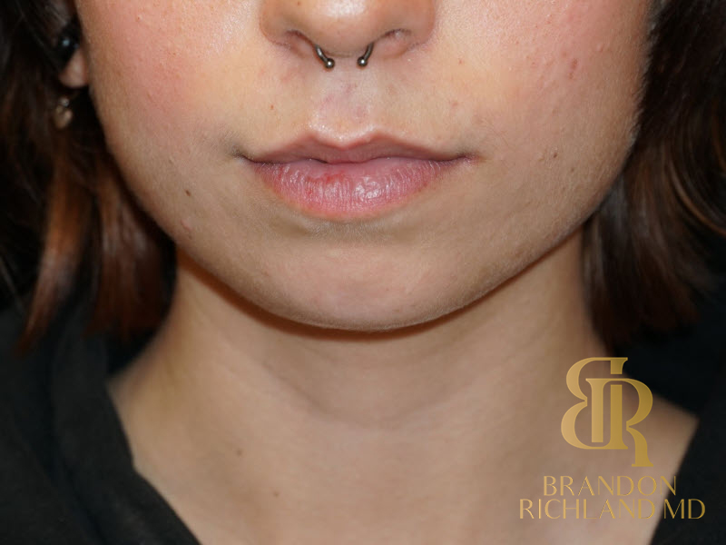 Dermal Fillers Before & After Image