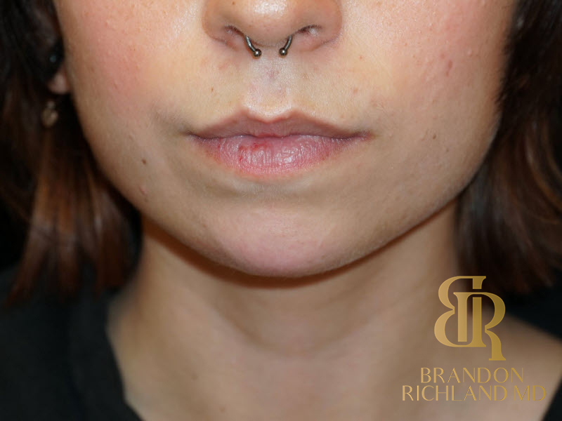 Dermal Fillers Before & After Image