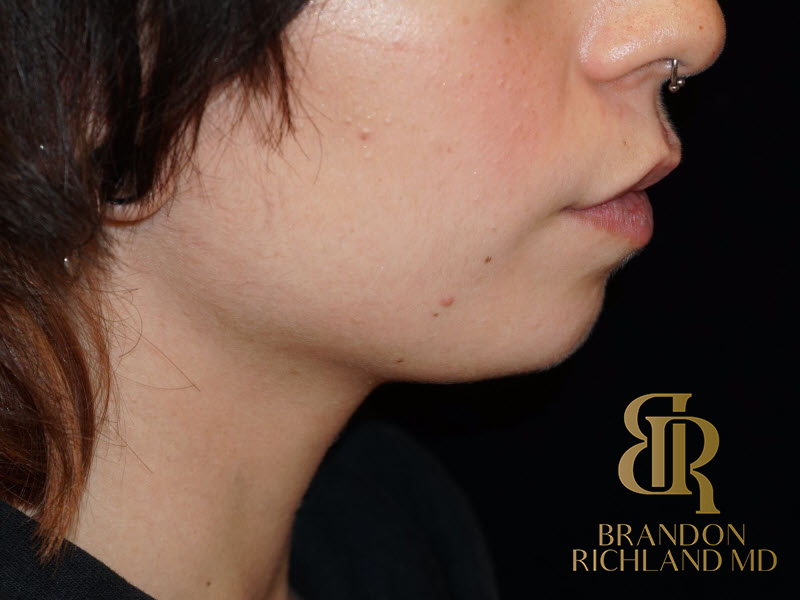 Dermal Fillers Before & After Image