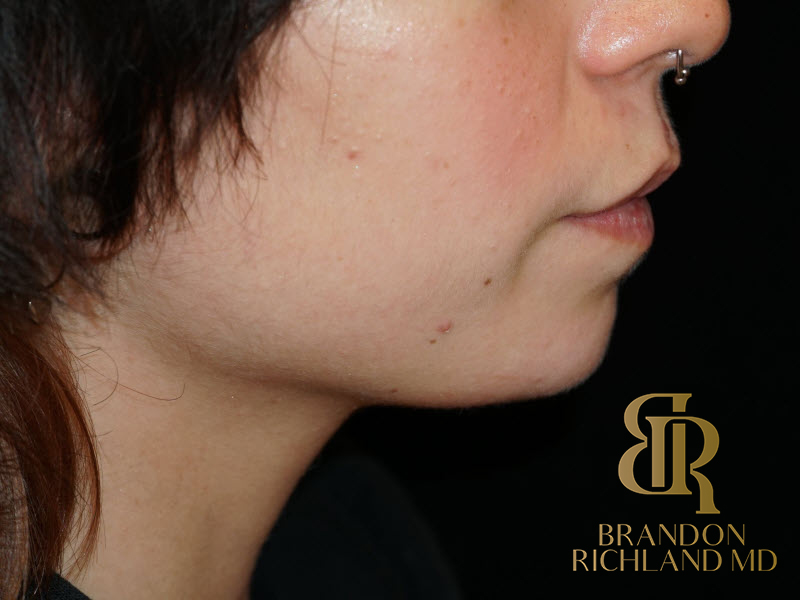 Dermal Fillers Before & After Image