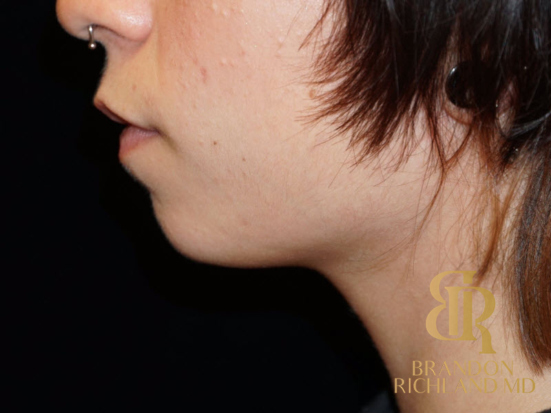 Dermal Fillers Before & After Image