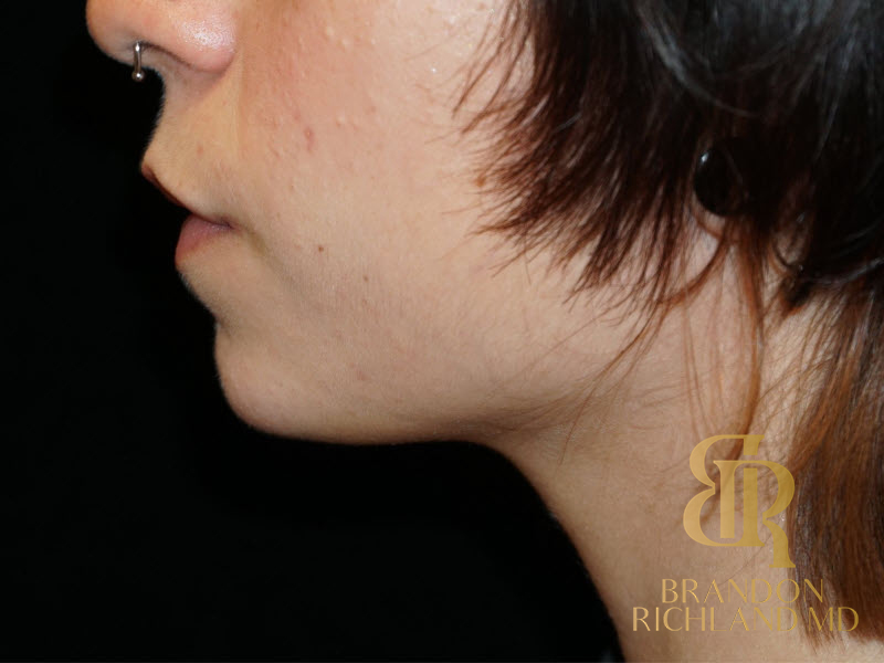 Dermal Fillers Before & After Image