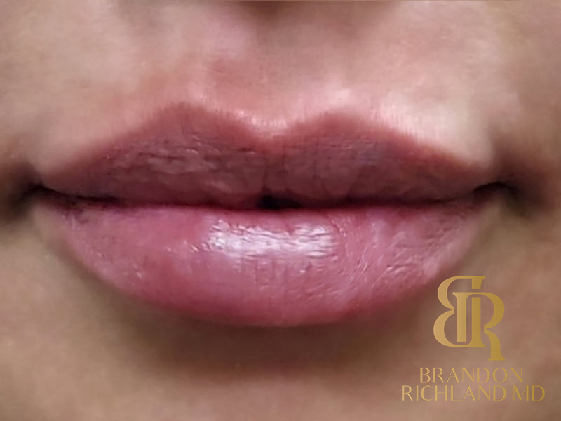 Dermal Fillers Before & After Image