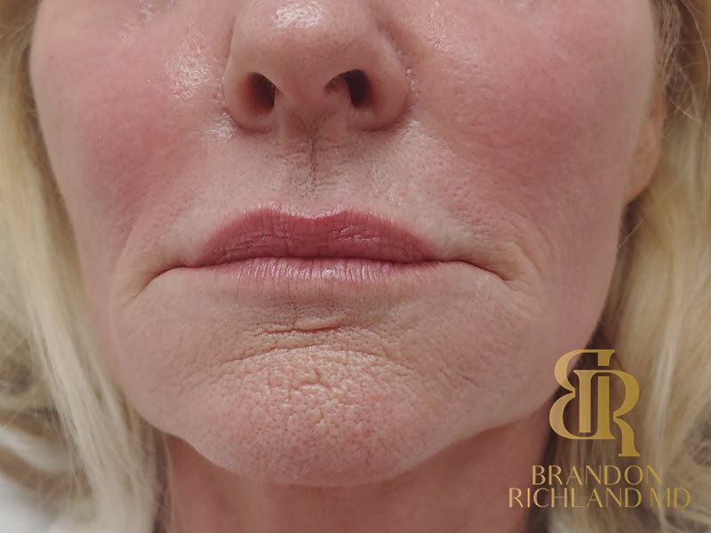 Dermal Fillers Before & After Image