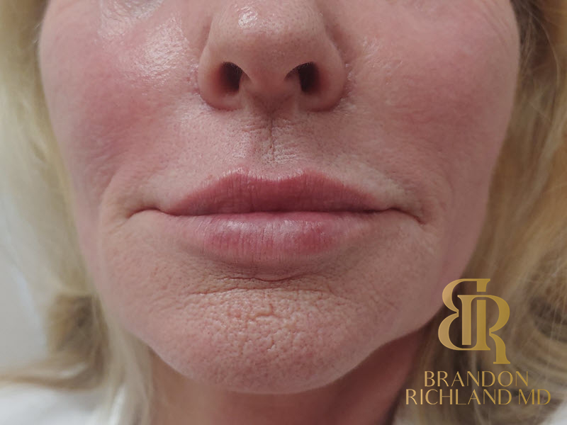 Dermal Fillers Before & After Image