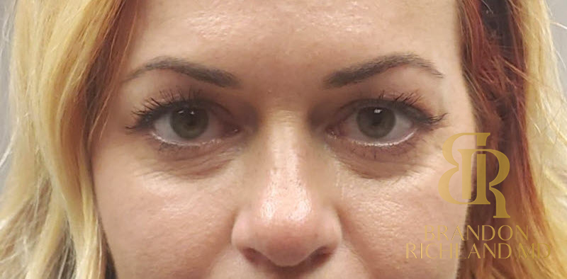 Dermal Fillers Before & After Image