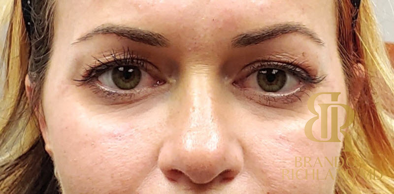 Dermal Fillers Before & After Image