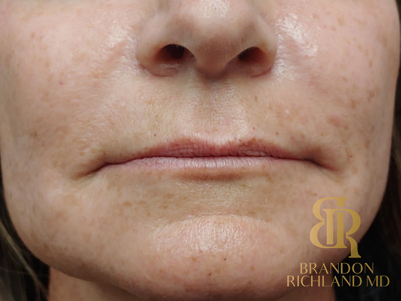 Dermal Fillers Before & After Image