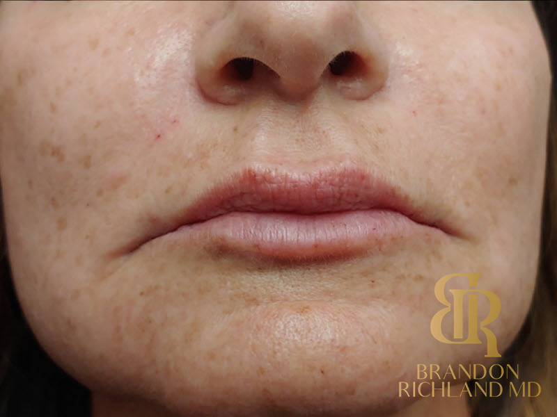 Dermal Fillers Before & After Image