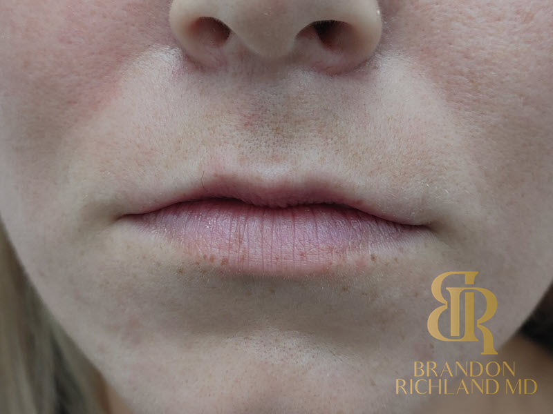 Dermal Fillers Before & After Image