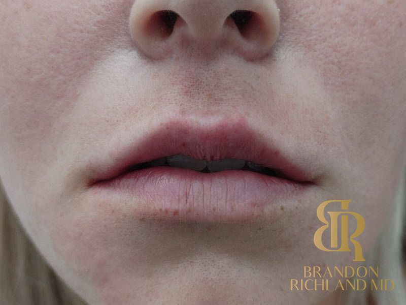 Dermal Fillers Before & After Image