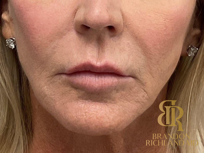 Dermal Fillers Before & After Image