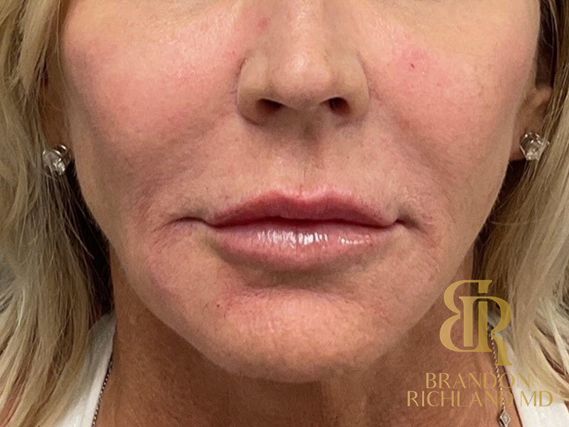 Dermal Fillers Before & After Image