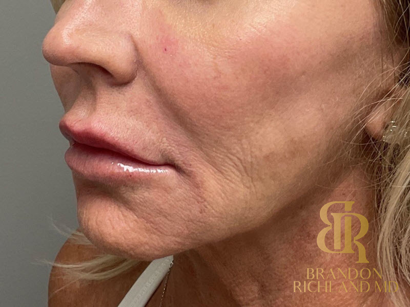 Dermal Fillers Before & After Image