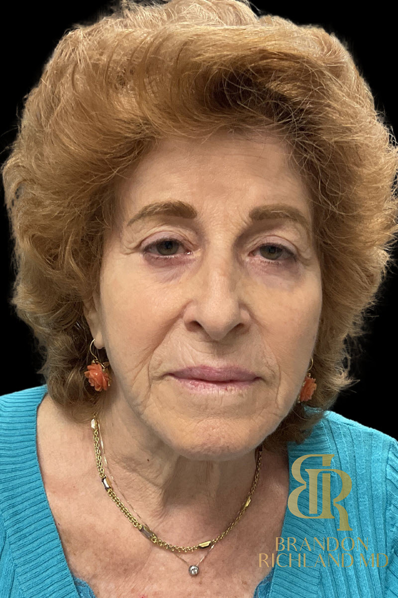 Dermal Fillers Before & After Image