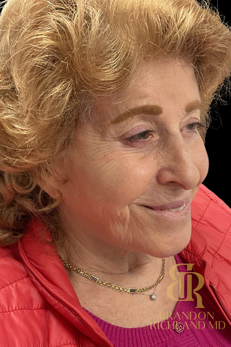 Dermal Fillers Before & After Image