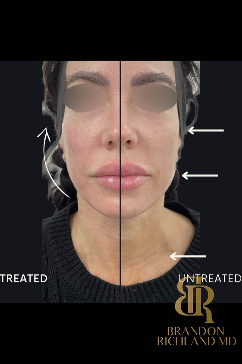 Forma Facial Before & After Image