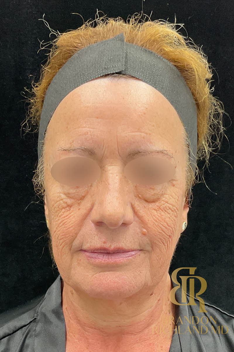 IPL Photofacials Before & After Image