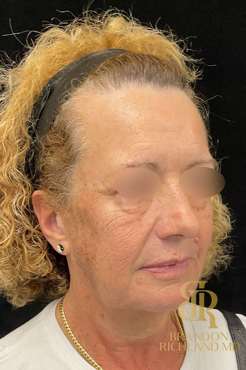 IPL Photofacials Before & After Image