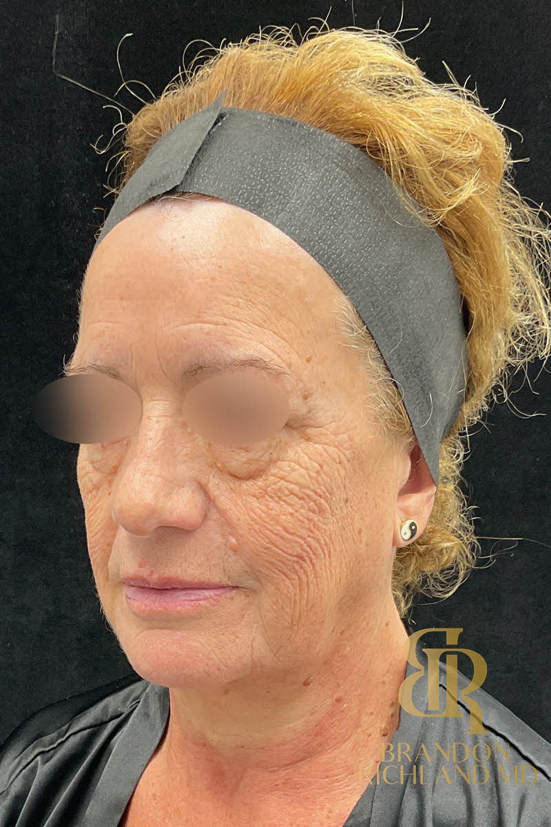 IPL Photofacials Before & After Image