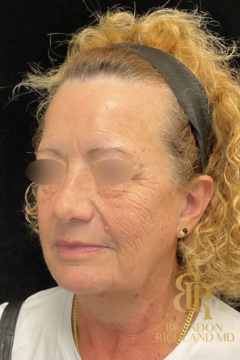IPL Photofacials Before & After Image