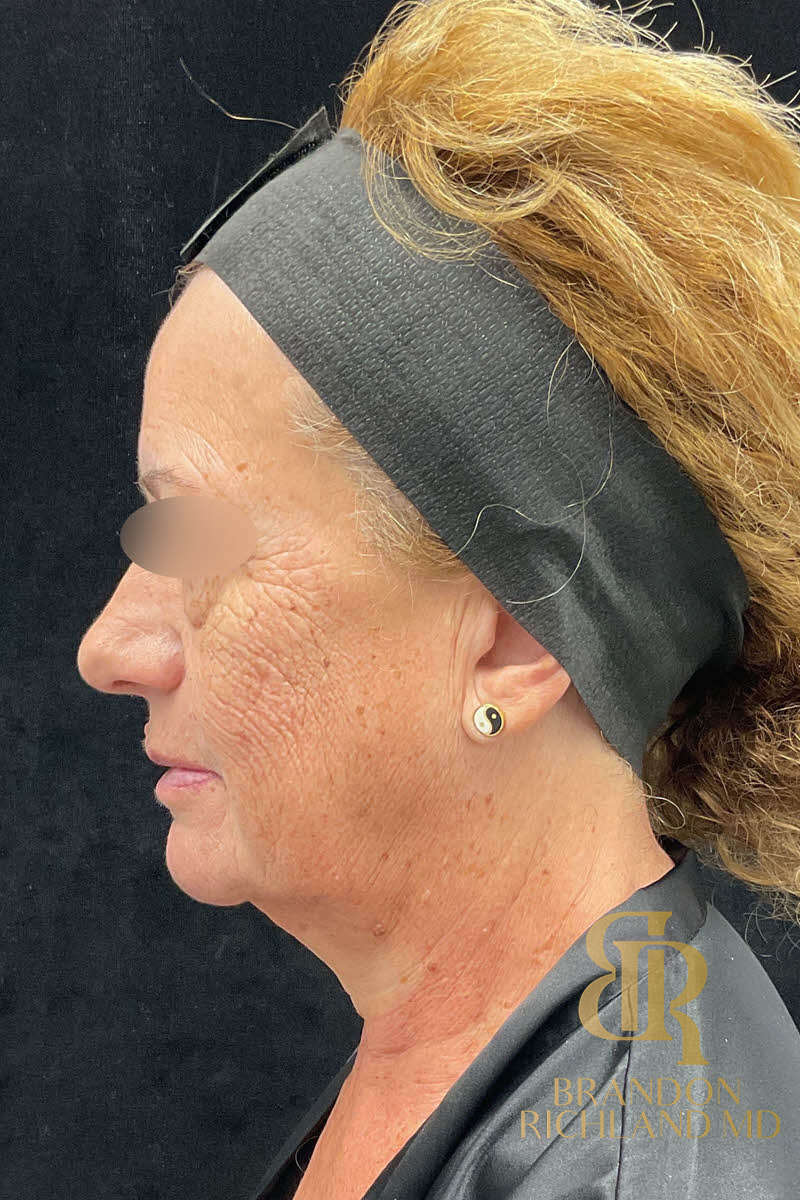 IPL Photofacials Before & After Image