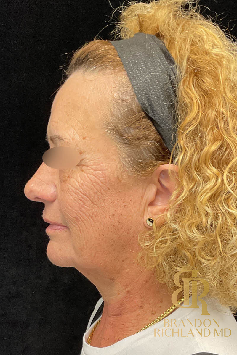 IPL Photofacials Before & After Image