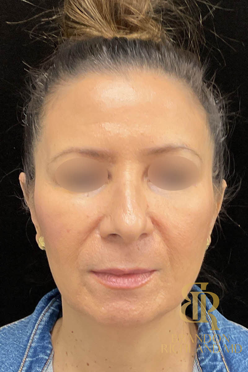 Morpheus8 Before & After Image