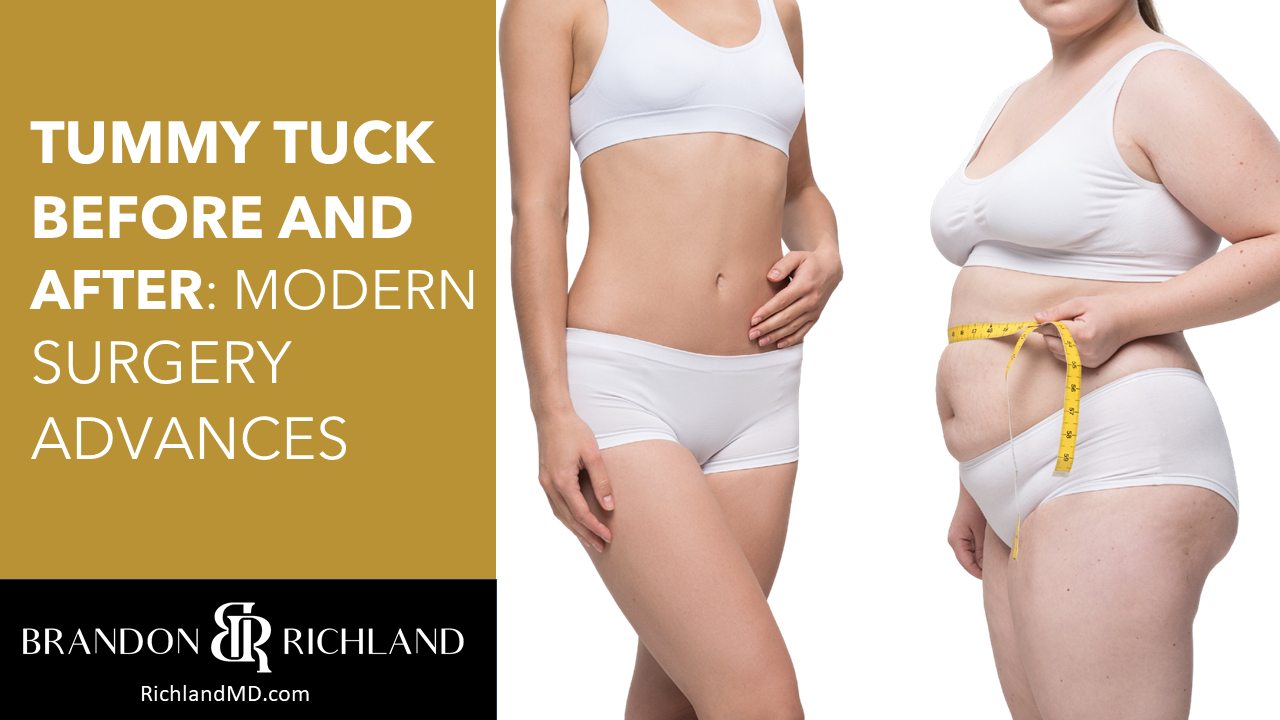 Tummy Tuck (Abdominoplasty), Woman - Age 40 - Before & After Photos