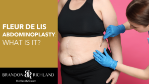 Fleur de Lis Abdominoplasty: What is it? Dr. Brandon Richland, MD