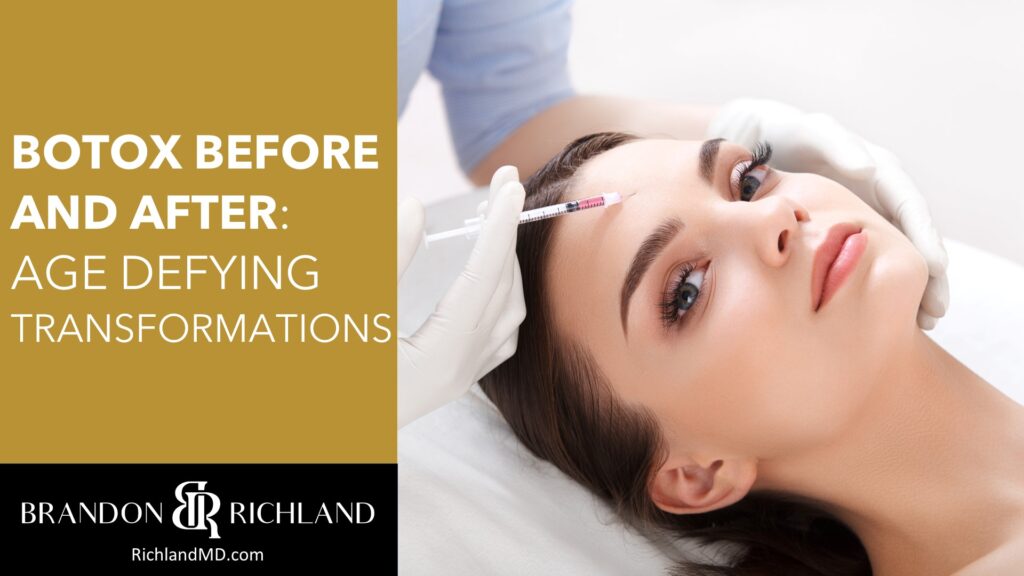 Botox Hyaluron Secrets Doctors Reveal The Best Before After Transformations - 87mgd9m