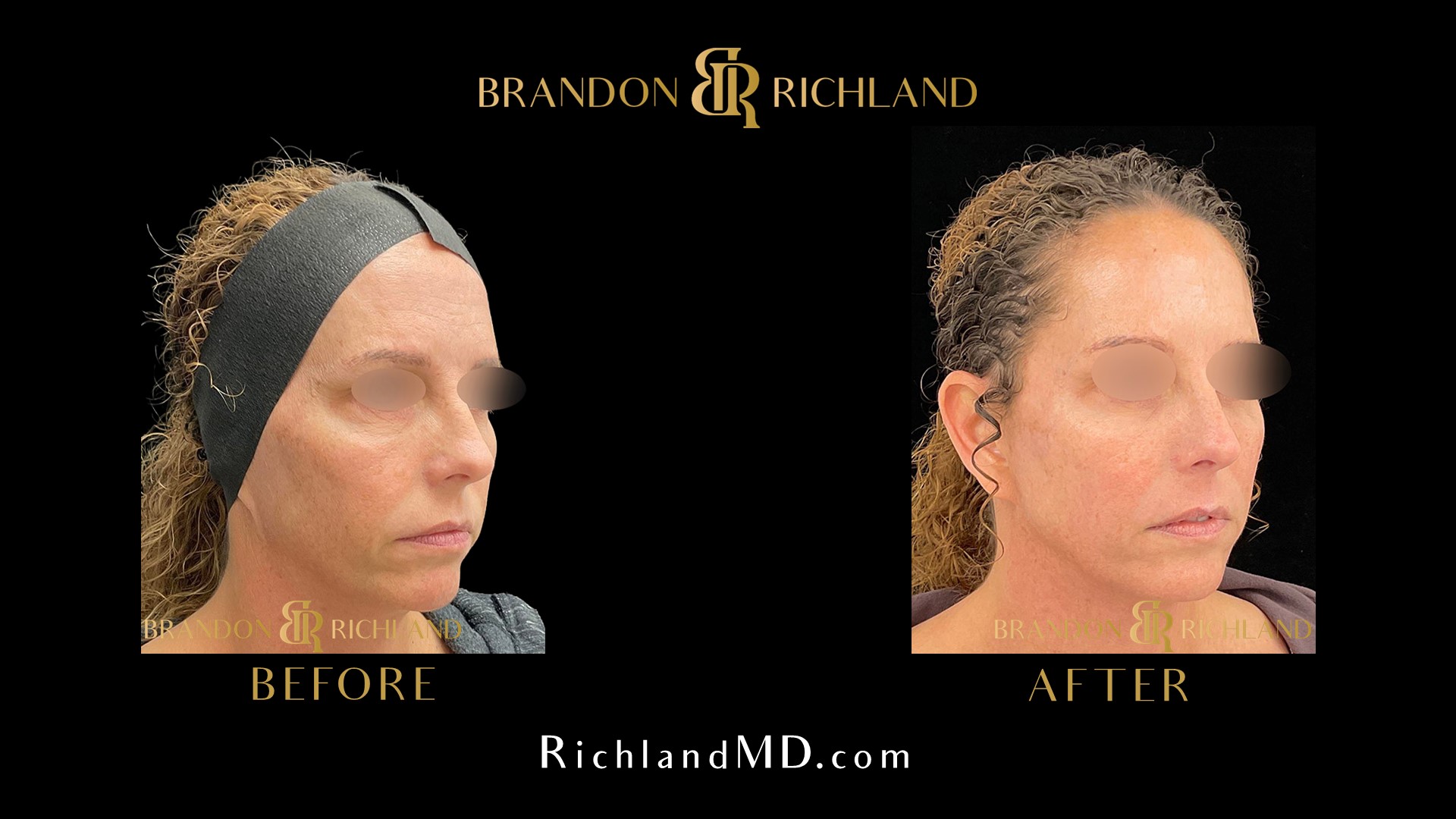 Morpheus8 Microneedling Before and After: Remarkable Results | Dr ...