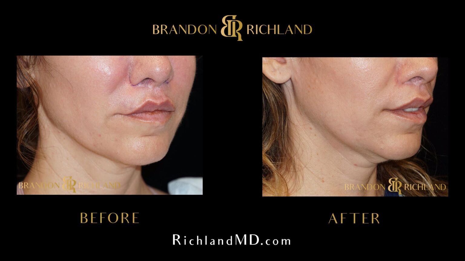 Lip Flip Before and After: Luscious Lips | Dr. Brandon Richland, MD