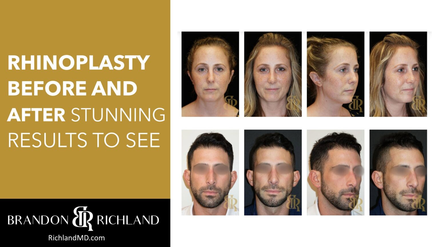 Rhinoplasty Before and After Stunning Results to See | Dr. Brandon ...