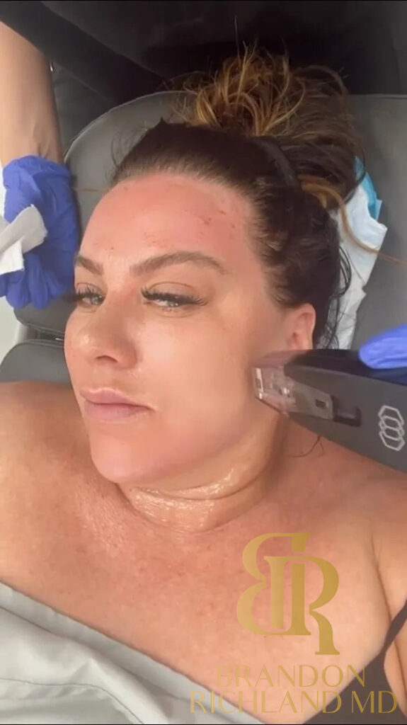 Morpheus8 Orange County: Amber Rose Facial Lounge 3 Months of Morpheus 8 Treatments in Newport Beach, CA By Dr. Brandon Richland, MD