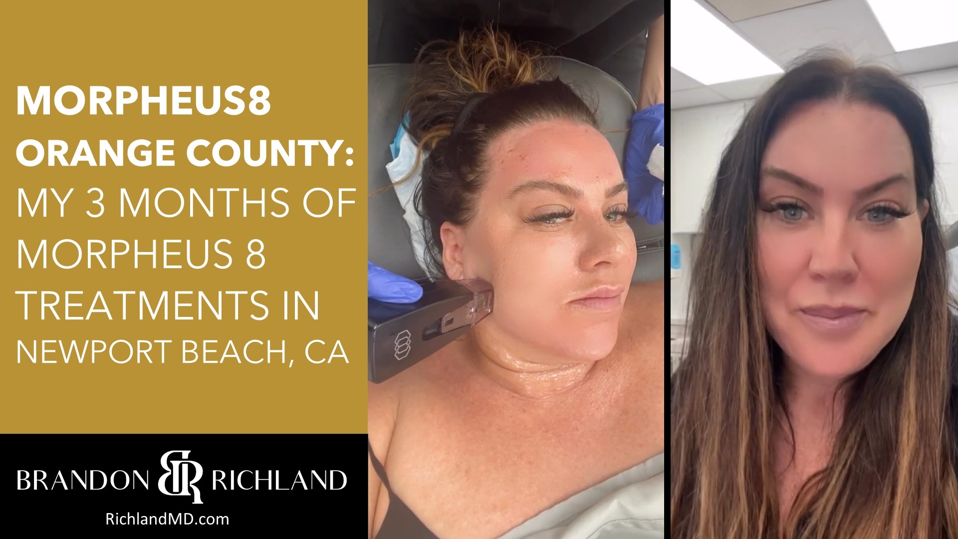 Morpheus8 Orange County: My 3 Months of Morpheus 8 Treatments in Newport Beach, CA By Dr. Brandon Richland, MD