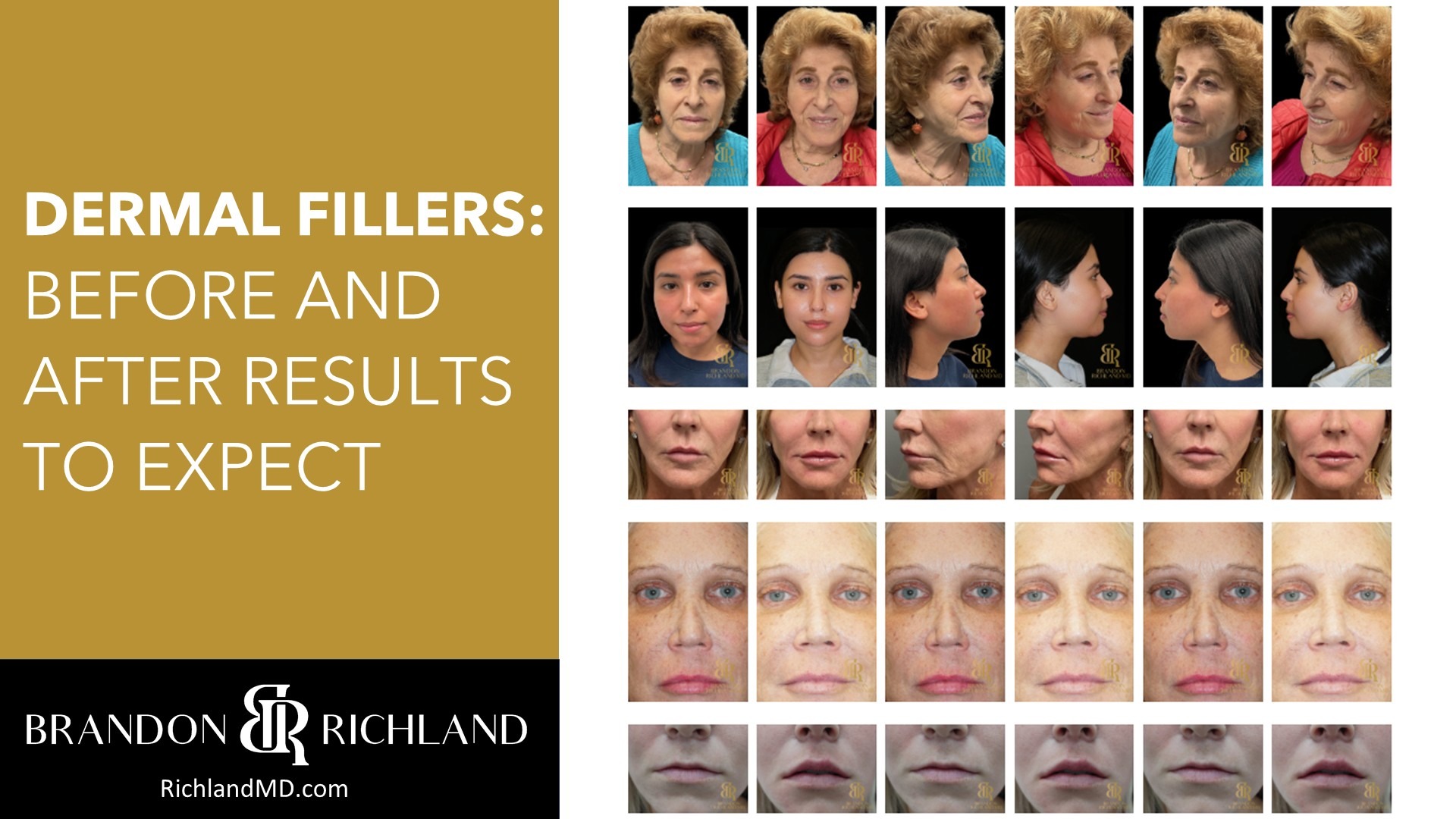 Dermal Fillers: Before and After Results to Expect by Dr. Brandon Richland, MD