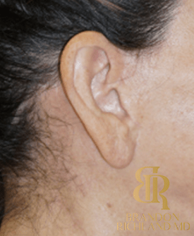Facelift Nearly Imperceptible Scars