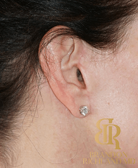 Facelift Nearly Imperceptible Scars by Dr. Richland Best Facial Plastic Surgeon in Orange County