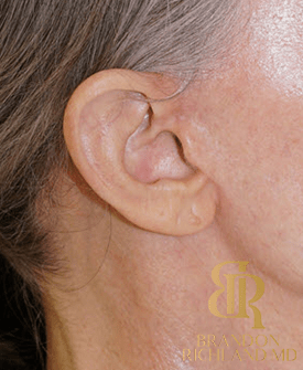 Facelift Nearly Imperceptible Scars by Dr. Richland Plastic Surgeon in Orange County