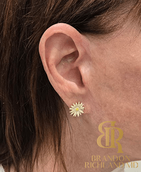 Facelift Nearly Imperceptible Scars by Dr. Brandon Richland