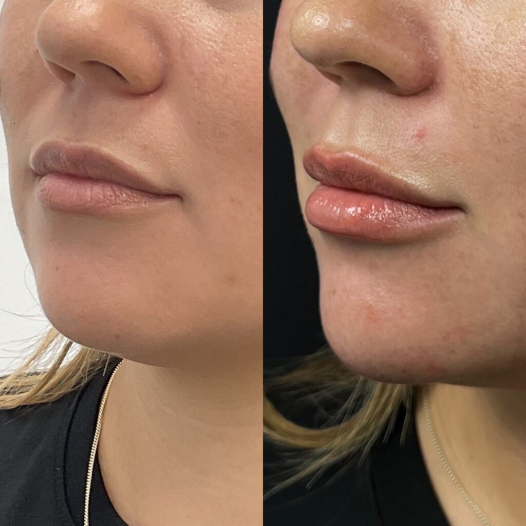 Lip Filler Special in Newport Coast, California