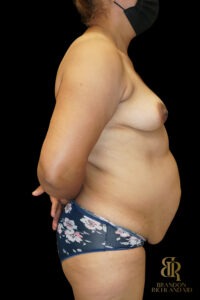 BBL before and after, Case #70422 — Dr. Brandon Richland, Newport Beach