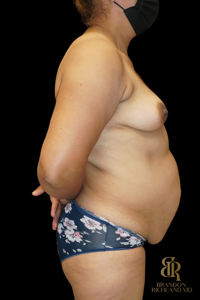 Tummy Tuck Before, Case #70422, view 3 — Dr. Brandon Richland, Newport Beach