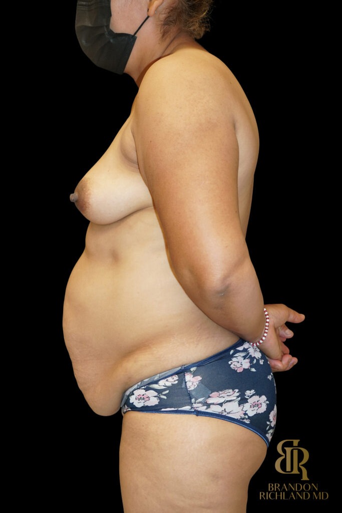 Tummy Tuck Before, Case #70422, view 5 — Dr. Brandon Richland, Newport Beach